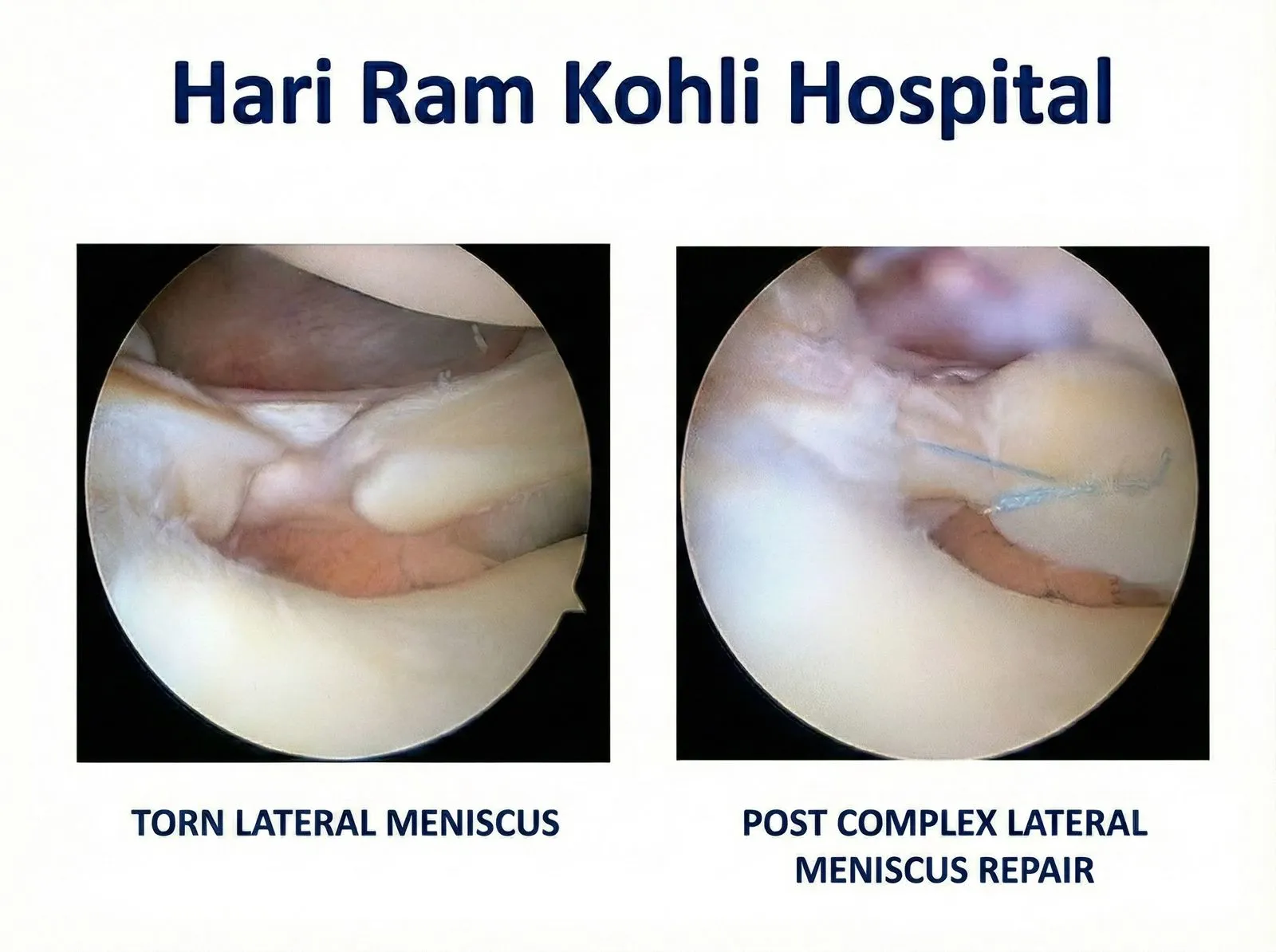 lateral meniscus