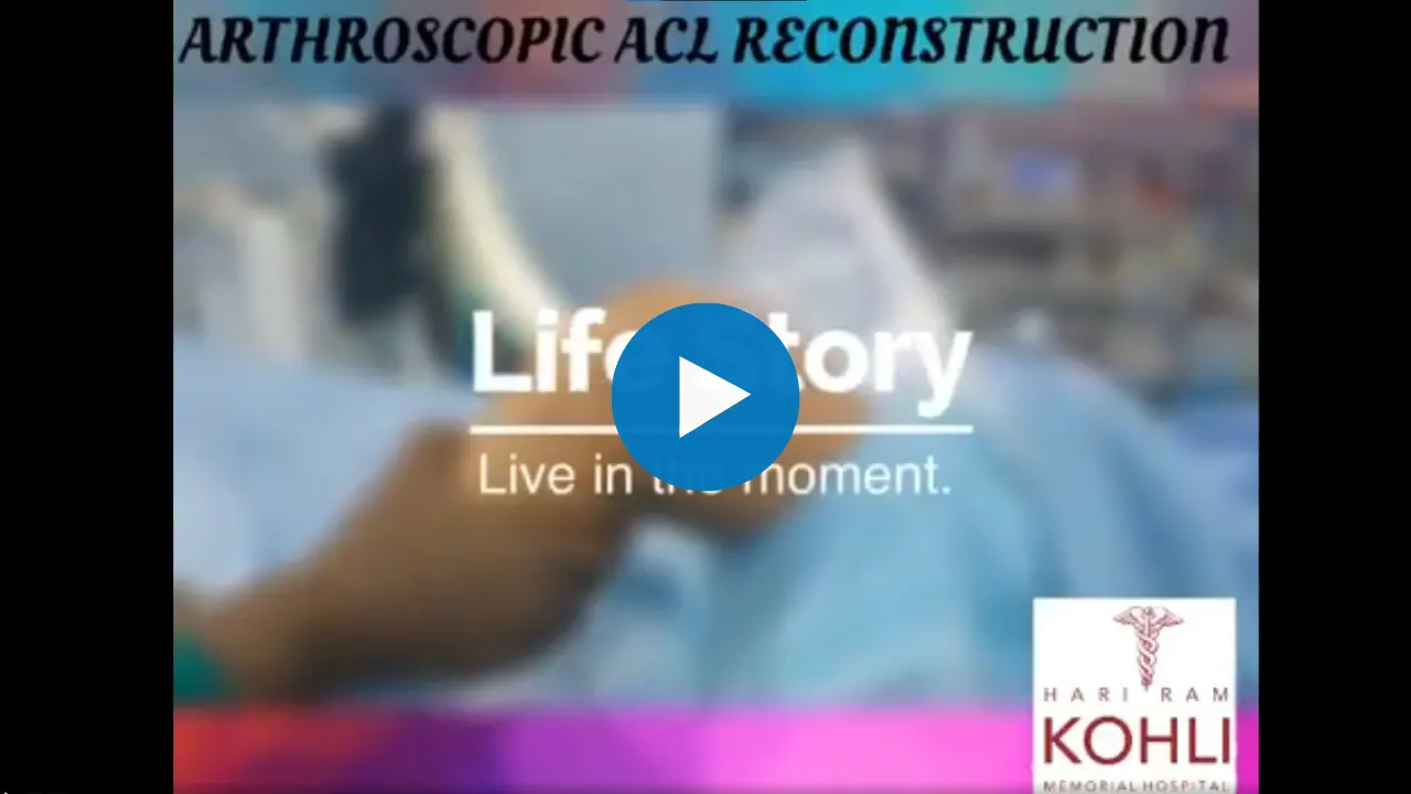 ACL reconstruction using the collapsible loop and bio screw technique